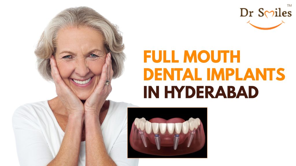 Full Mouth Dental Implants in Hyderabad